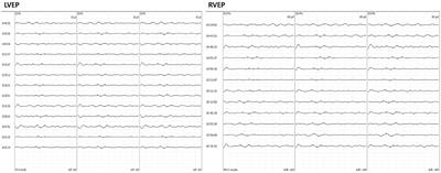 Prediction of Post-operative Visual Deterioration Using Visual-Evoked Potential Latency in Extended Endoscopic Endonasal Resection of Craniopharyngiomas